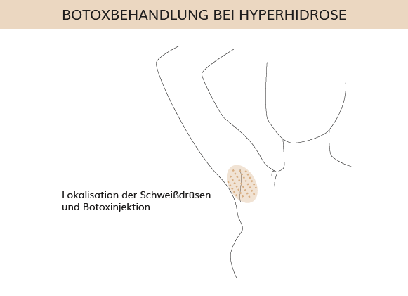 Botoxbehandlung Hyperhidrose, Dr. Weihrauch, Plastische & Ästhetische Chirurgie in Karlsruhe 