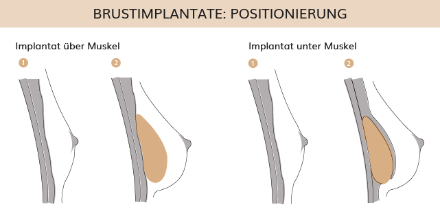 Positionierung Brustimplantate, Dr. Weihrauch, Plastische & Ästhetische Chirurgie in Karlsruhe 