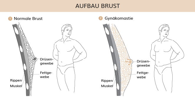 Aufbau Brust, Dr. Weihrauch, Plastische & Ästhetische Chirurgie in Karlsruhe 