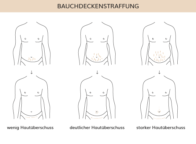 Bauchdeckenstraffung, Dr. Weihrauch, Plastische & Ästhetische Chirurgie in Karlsruhe 