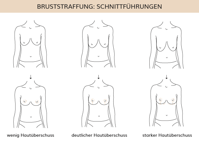 Bruststraffung Schnittführung, Dr. Weihrauch, Plastische & Ästhetische Chirurgie in Karlsruhe 