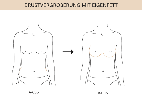 Brustvergrößerung mit Eigenfett, Dr. Weihrauch, Plastische & Ästhetische Chirurgie in Karlsruhe 