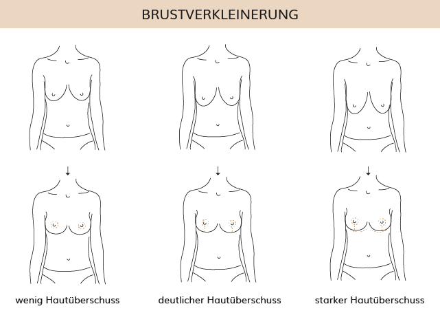 Brustverkleinerung, Dr. Weihrauch, Plastische & Ästhetische Chirurgie in Karlsruhe 