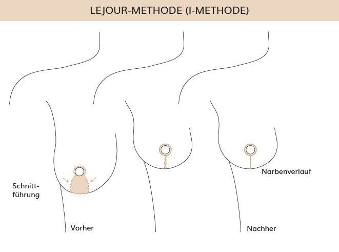 Brustverkleinerung Lejour Methode, Dr. Weihrauch, Plastische & Ästhetische Chirurgie in Karlsruhe 