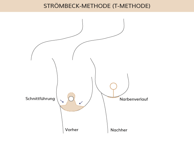 Brustverkleinerung Strömbeck Methode, Dr. Weihrauch, Plastische & Ästhetische Chirurgie in Karlsruhe 