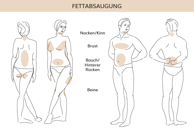 Fettabsaugung, Dr. Weihrauch, Plastische & Ästhetische Chirurgie in Karlsruhe 