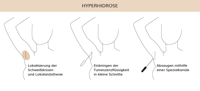 Hyperhidrose, Dr. Weihrauch, Plastische & Ästhetische Chirurgie in Karlsruhe 