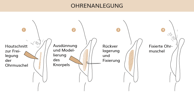 Ohrenanlegung, Dr. Weihrauch, Plastische & Ästhetische Chirurgie in Karlsruhe